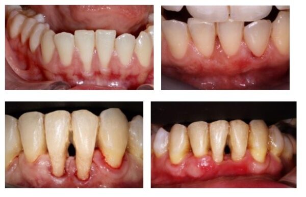 Greffes De Gencive Parodontologie Implantologie Dr Para Paris