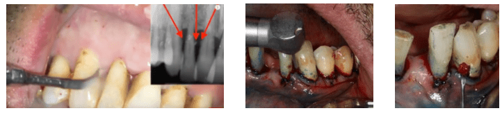 Parodontologie laser assistée