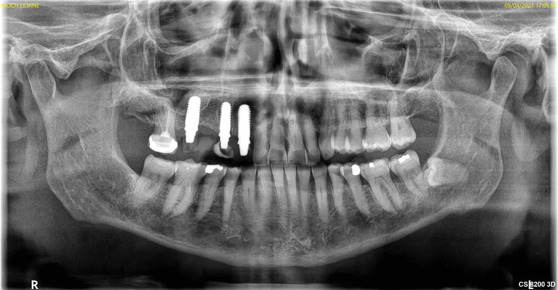 Radiographie panoramique avec implants