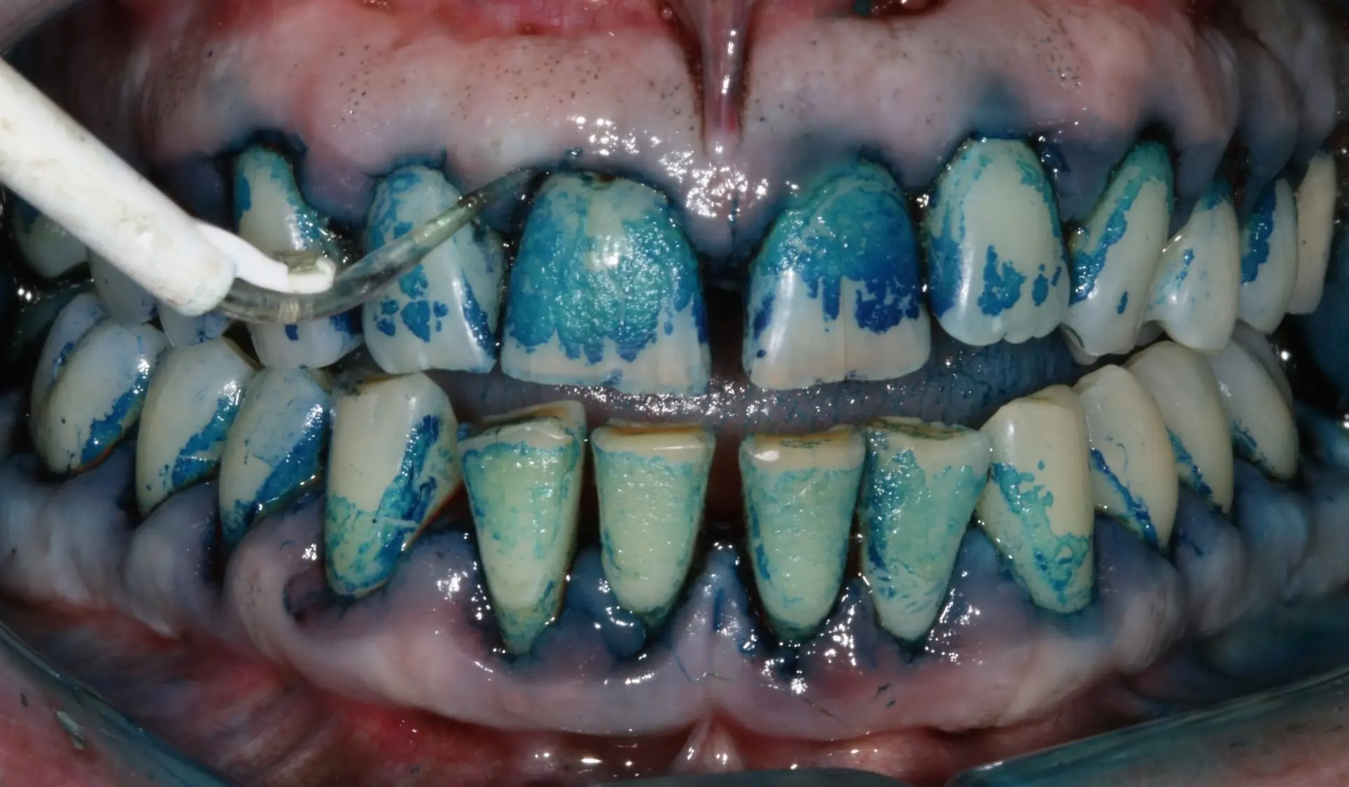 Traitement des péri-implantites