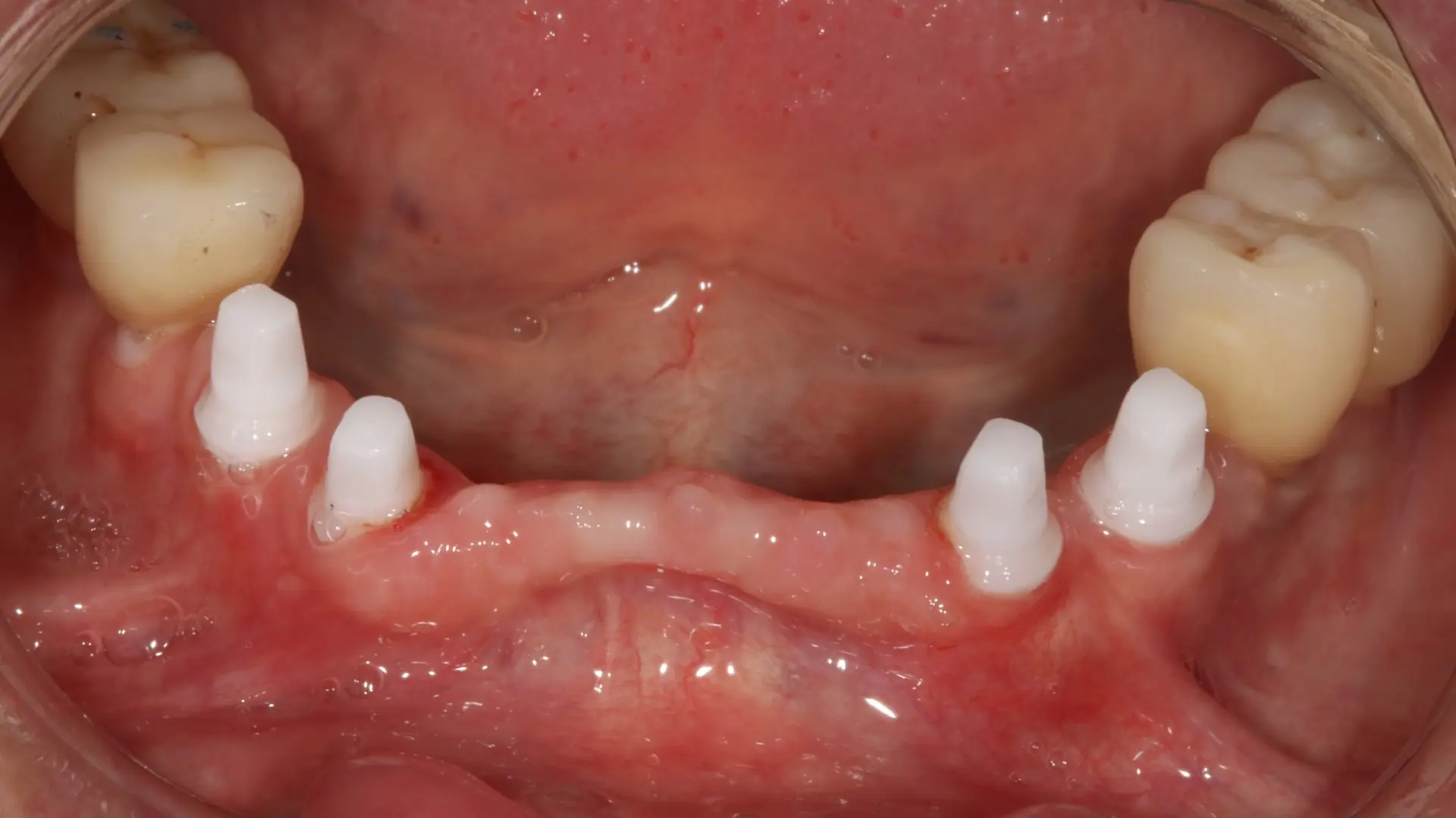 Implants céramiques en bouche